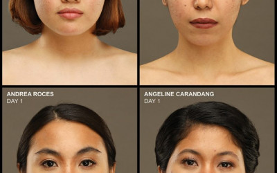 Maxi-Peel Encourages Women with Troubled Skin: "'Wag Mong Isuko Ang Laban!"